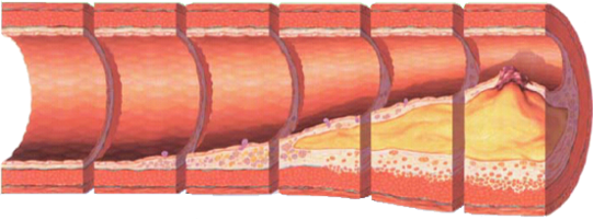 Sketch with stages of atherosclerosis