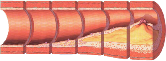 Stadien der Atherosklerose